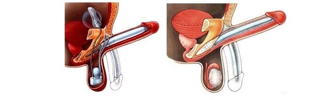 prótesis de ampliación do pene