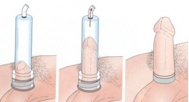 Aumento do pene mediante unha bomba